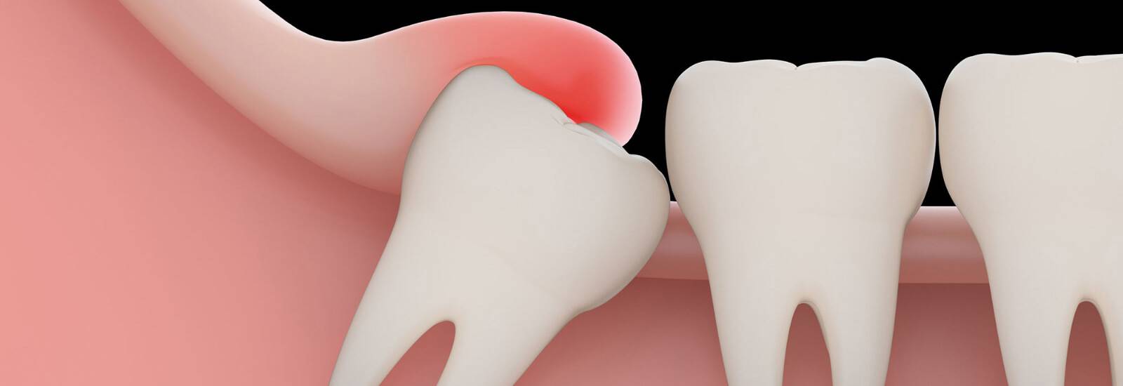 Wisdom Tooth Extraction