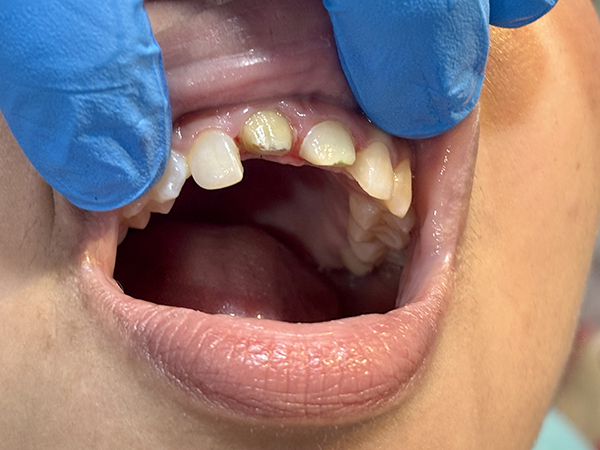 best Paediatric Dentistry treatment in patuli,garia, kolkata