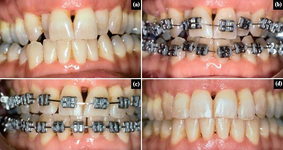 Dental Bridges
