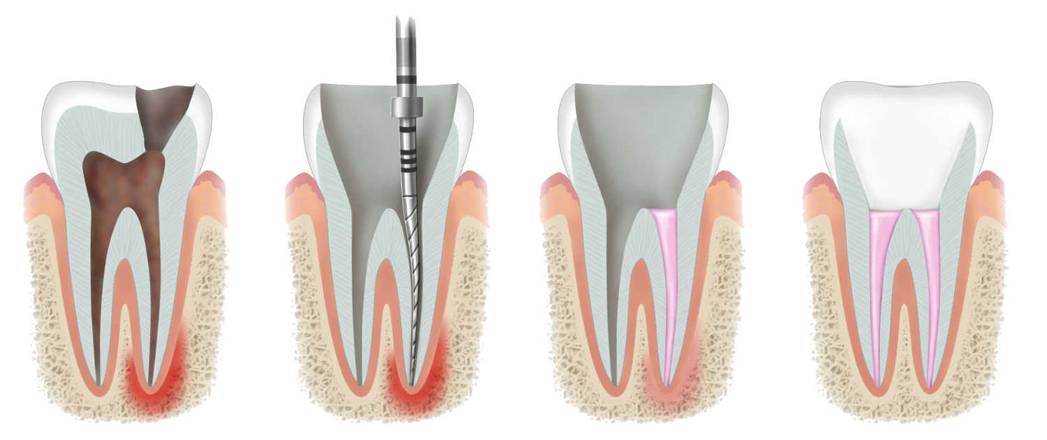 root-canal-treatment