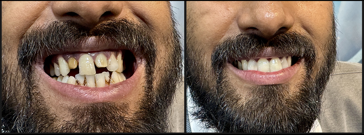 Scaling and Polishing