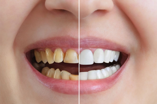 Tooth Whitening Treatment By Mr and Mrs Dentist