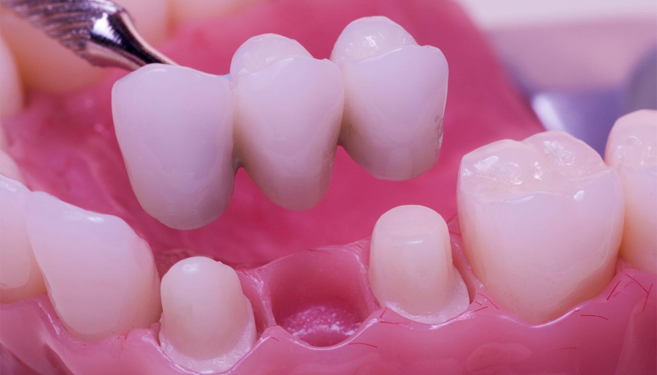 dental bridges