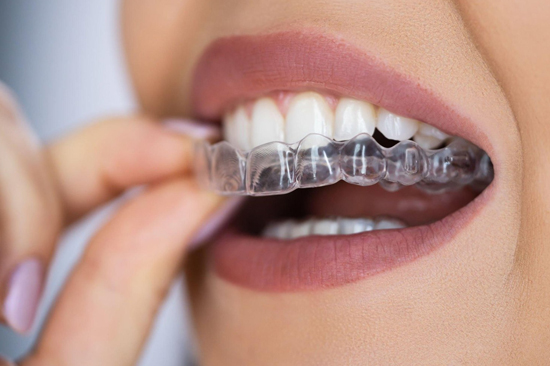 best invisaligner in patuli,rajpur sonarpur