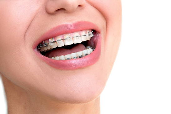 best orthodontic treatment in patuli,rajpur sonarpur