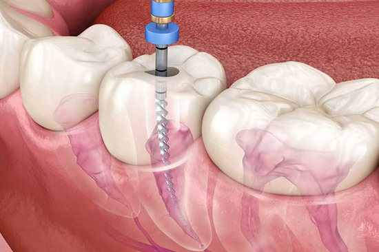 RCT Root Canal By Mr and Mrs Dentist