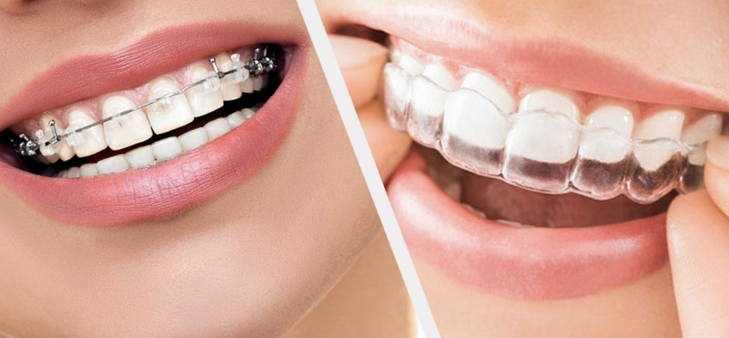 orthodontic treatment in garia, patuli