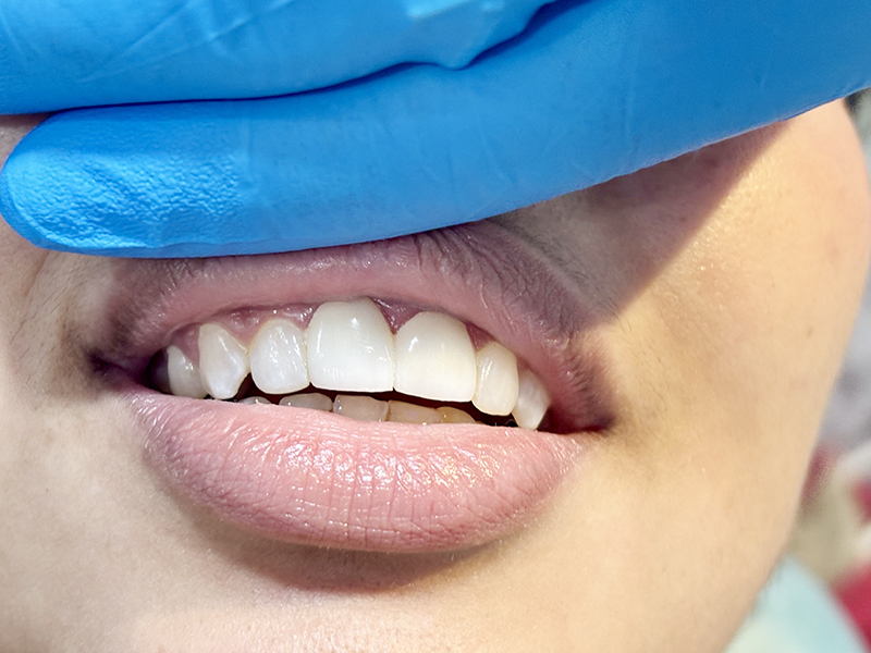 Tooth Whitening Treatment