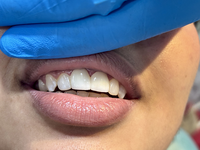 Tooth Whitening Treatment